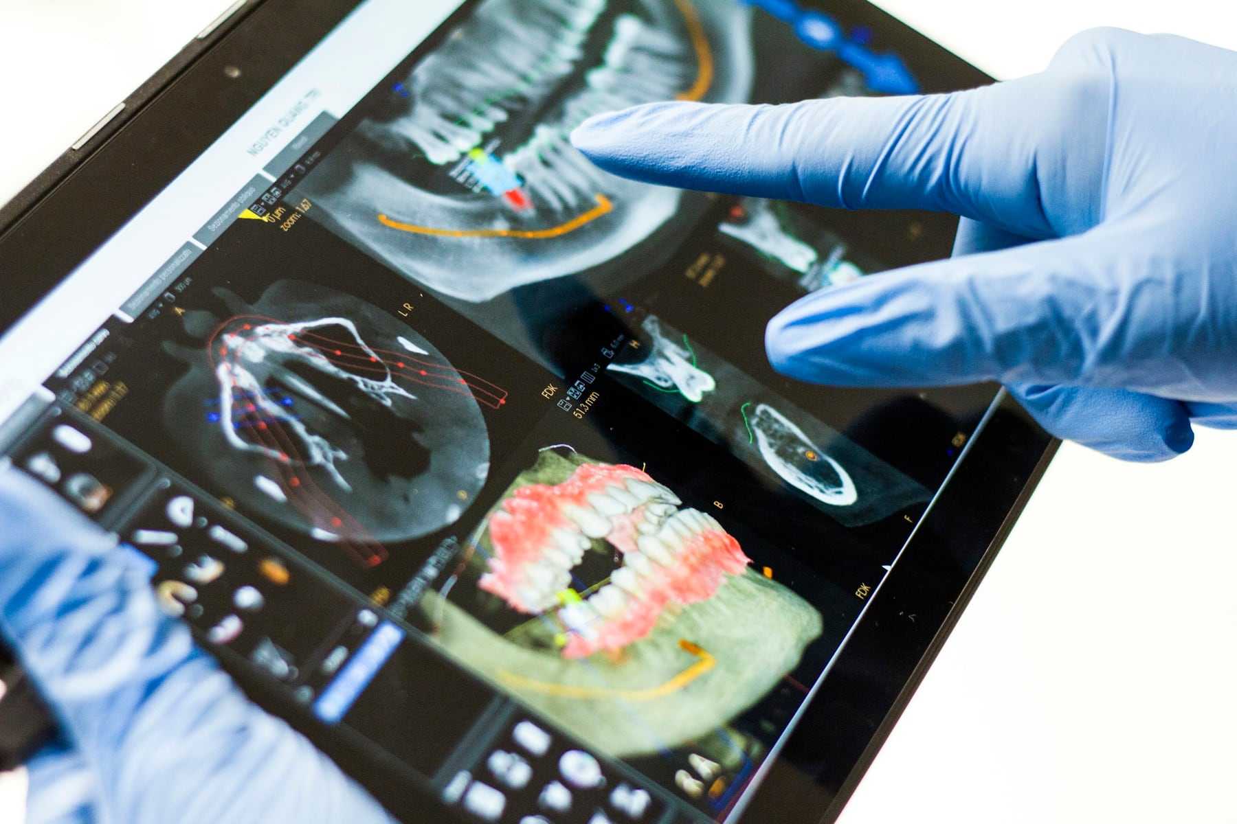 A dentist pointing at a 3D dental scan on a tablet